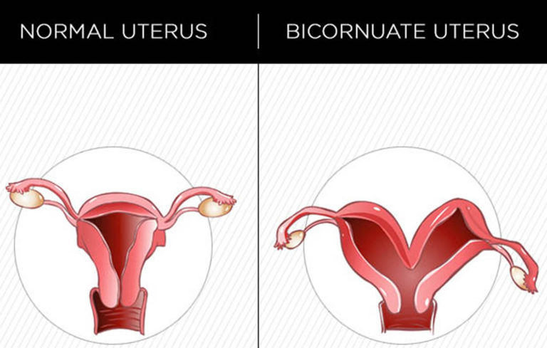 Bicornuate Uterus - Causes, Symptoms, Ultrasound, Fertility & Pregnancy