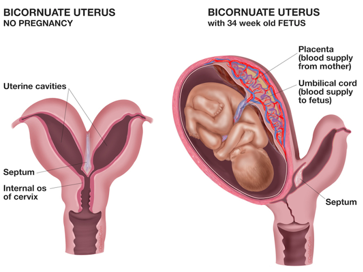 Bicornuate Uterus Causes Symptoms Ultrasound Fertility Pregnancy