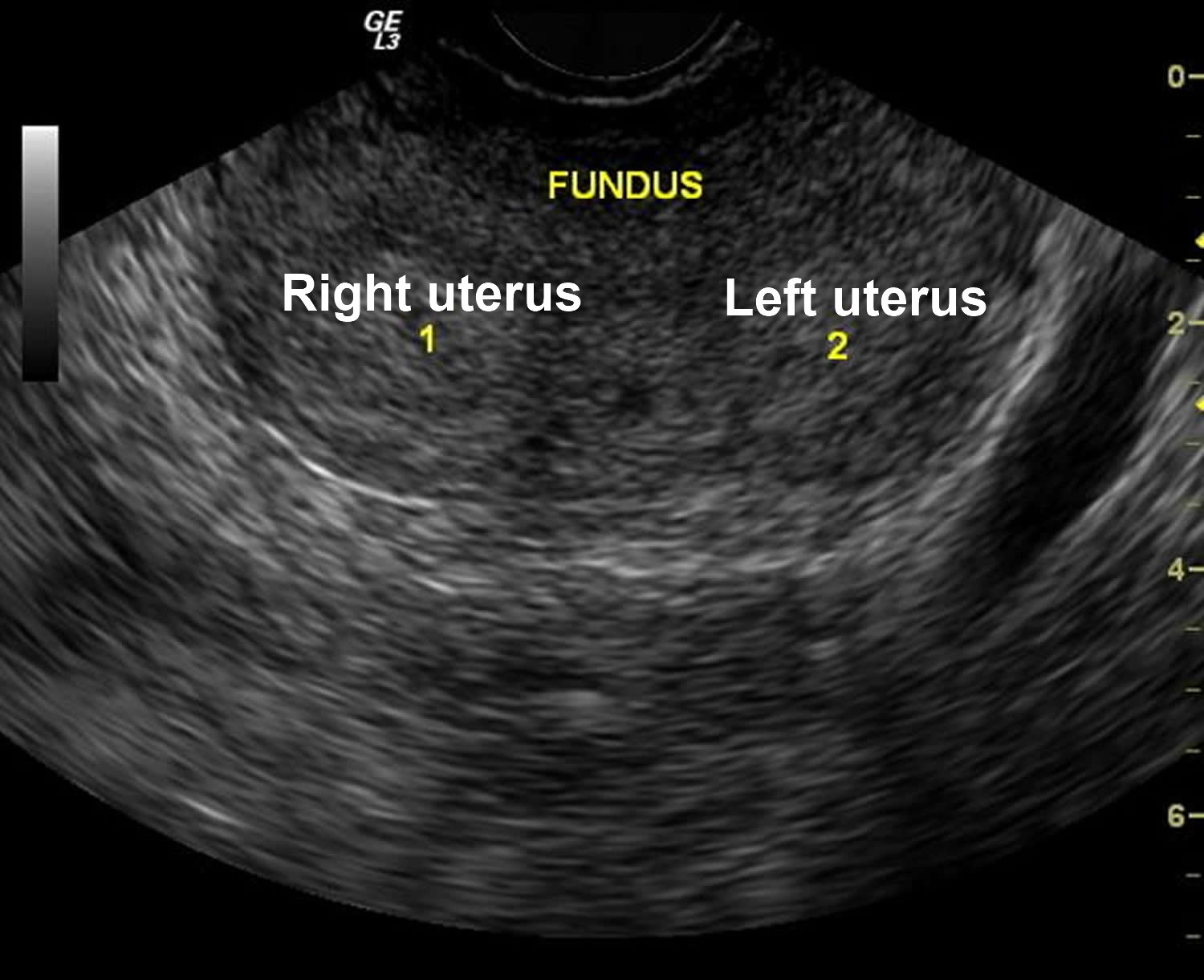 bicornuate uterus ultrasound