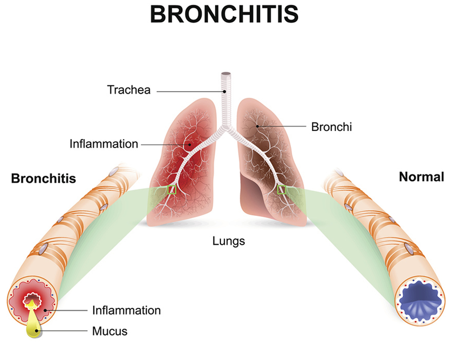 How Long Does A Viral Bronchitis Cough Last