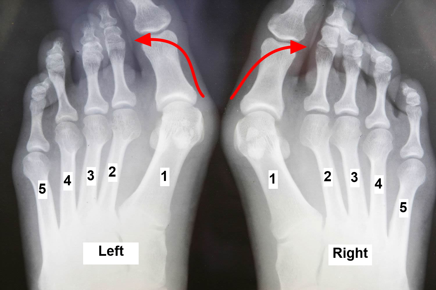 Foot Bunion - Causes, Symptoms, and Treatment To Correct Bunion