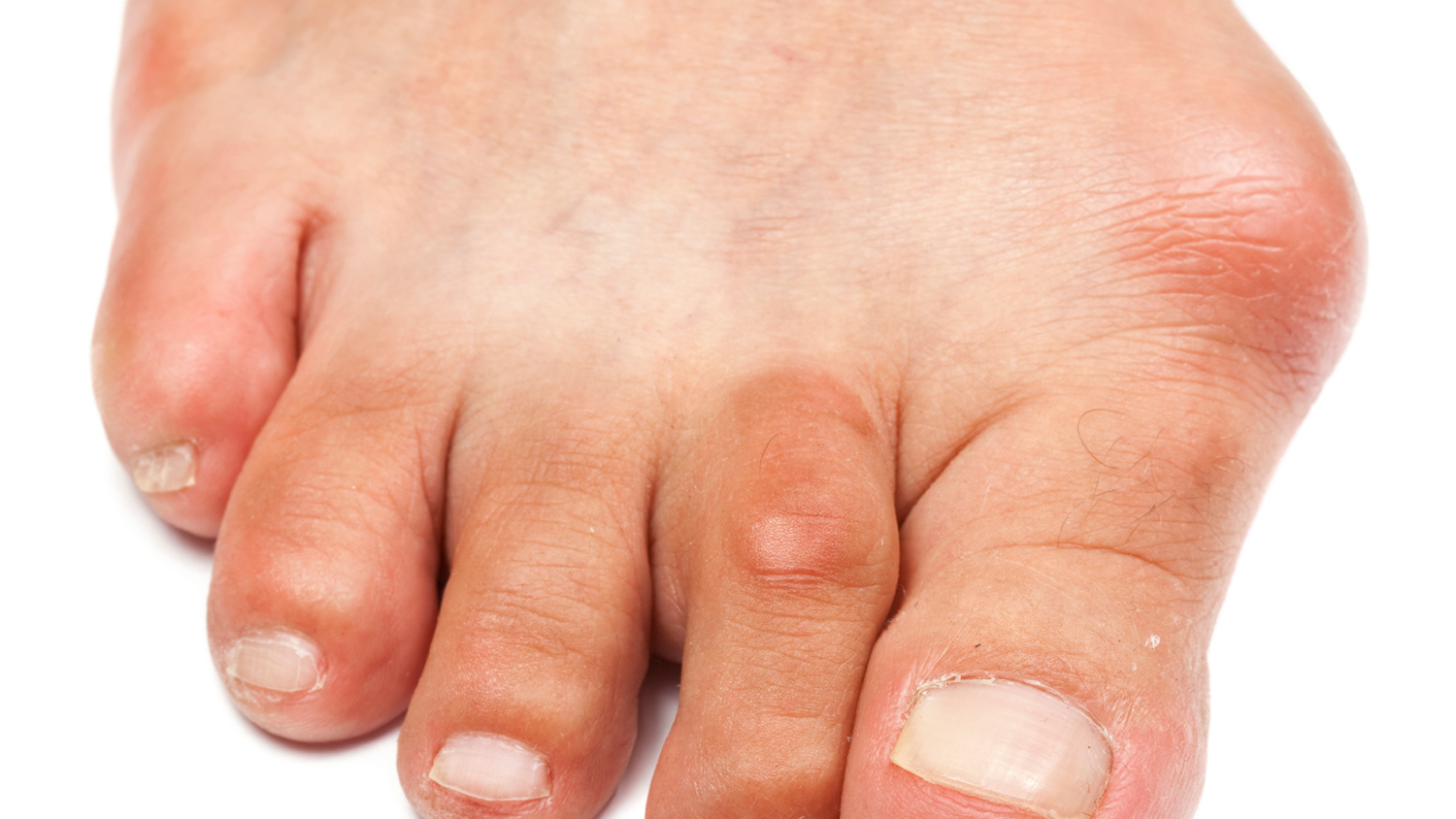 Foot Bunion Causes Symptoms And Treatment To Correct Bunion   Bunion 