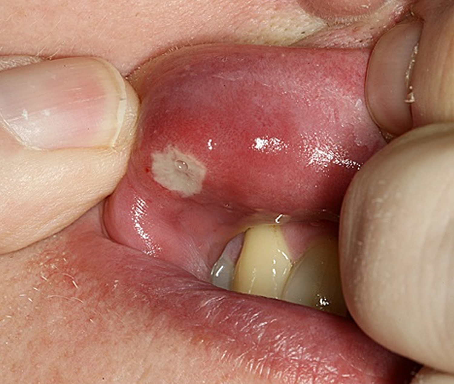 canker sore