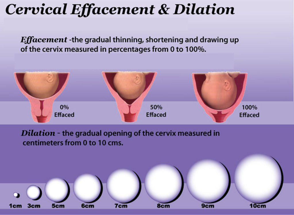 Cervix - Incompetent, Effaced, Short, Soft, and Low cervix