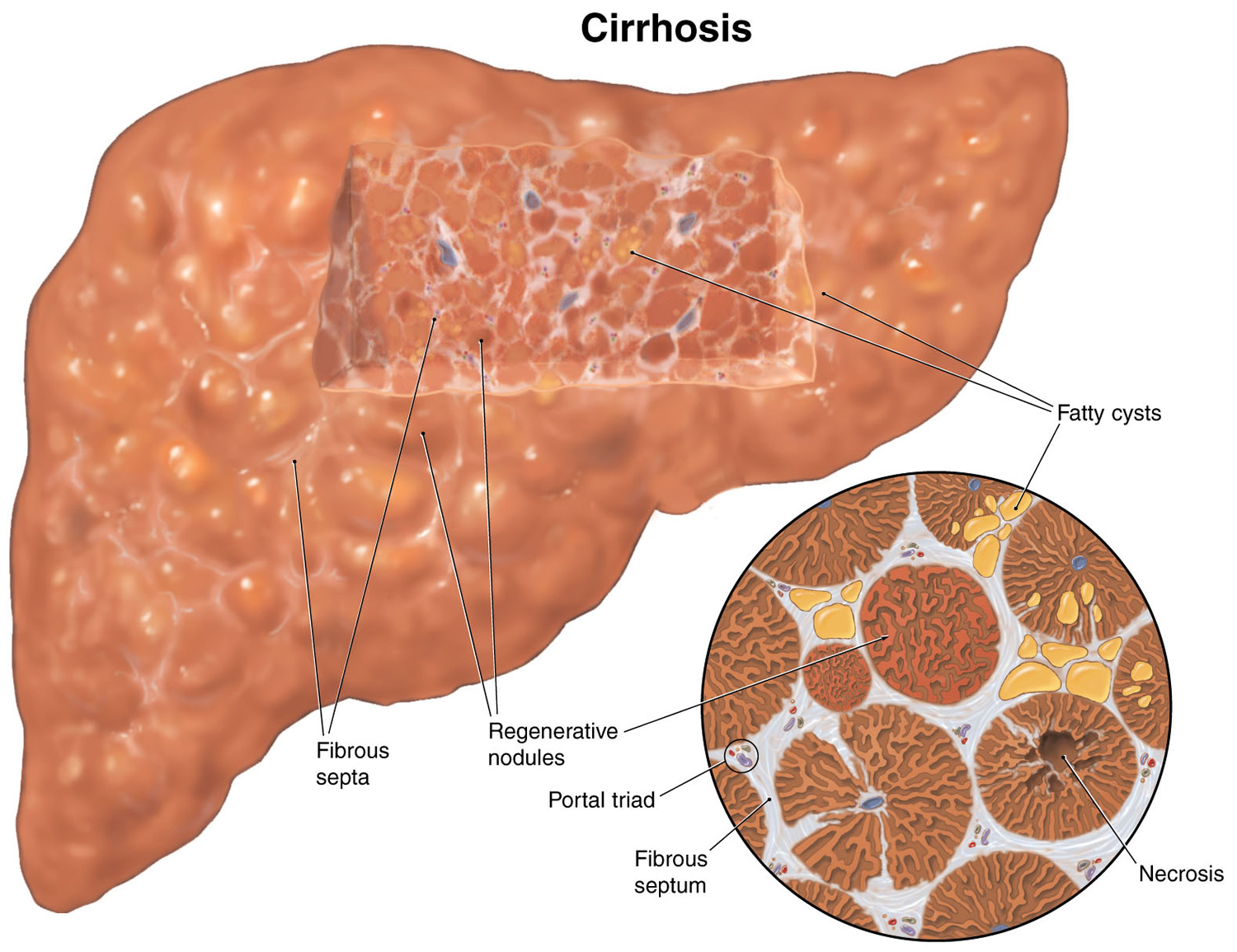 latest medicine research for liver cirrhosis