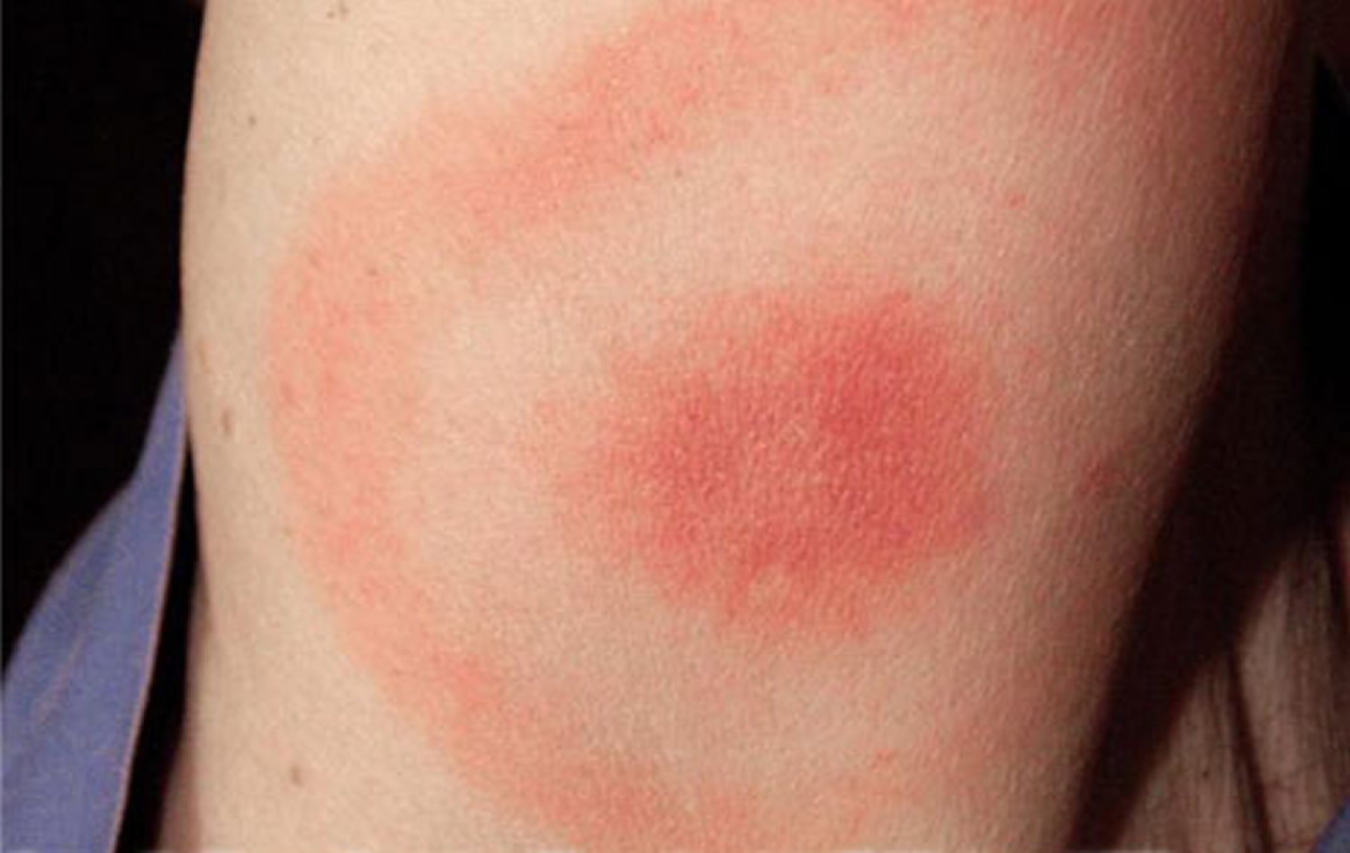 classic lyme disease rash