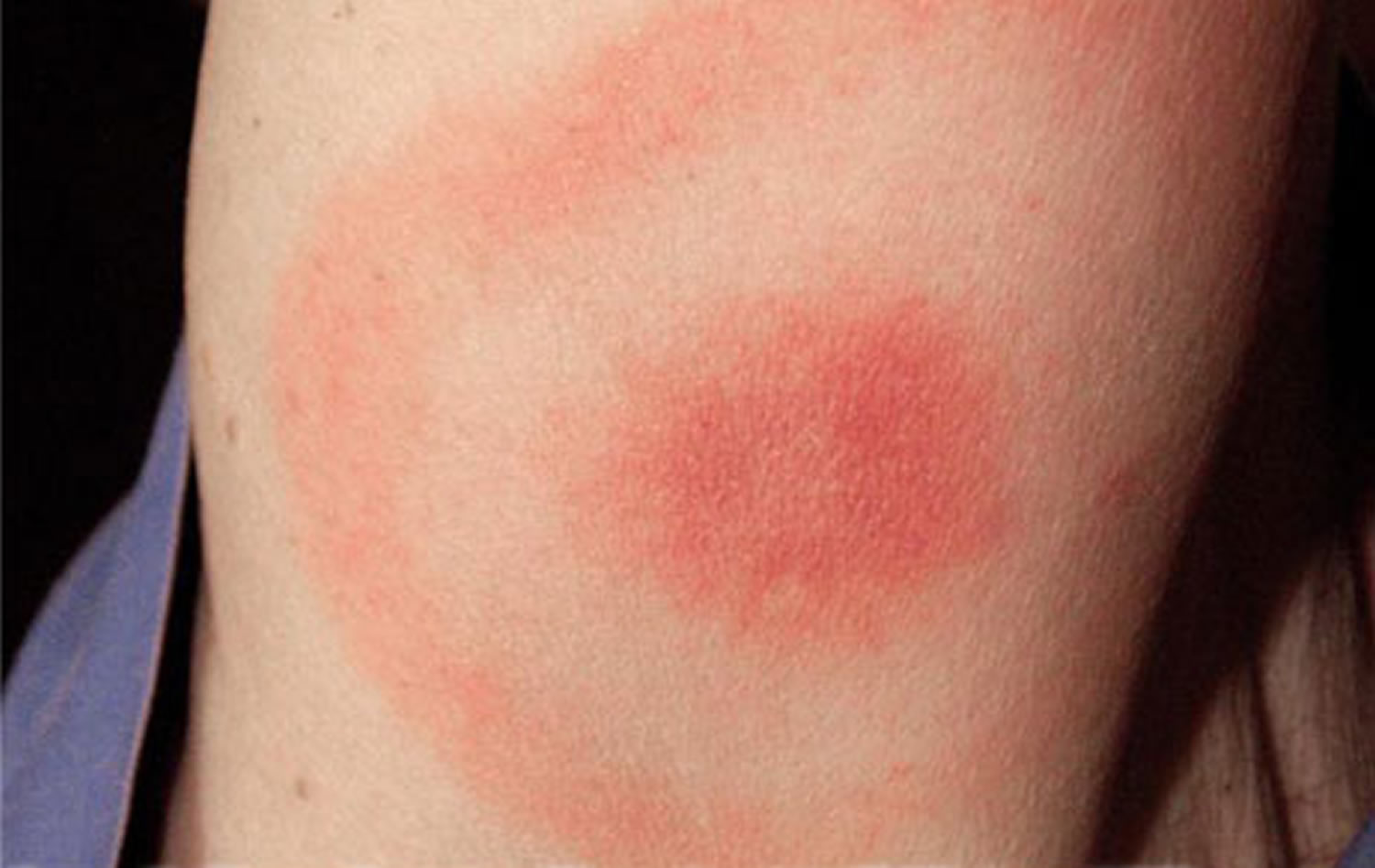 Lyme Disease Rash Causes Symptoms Diagnosis And Treatment