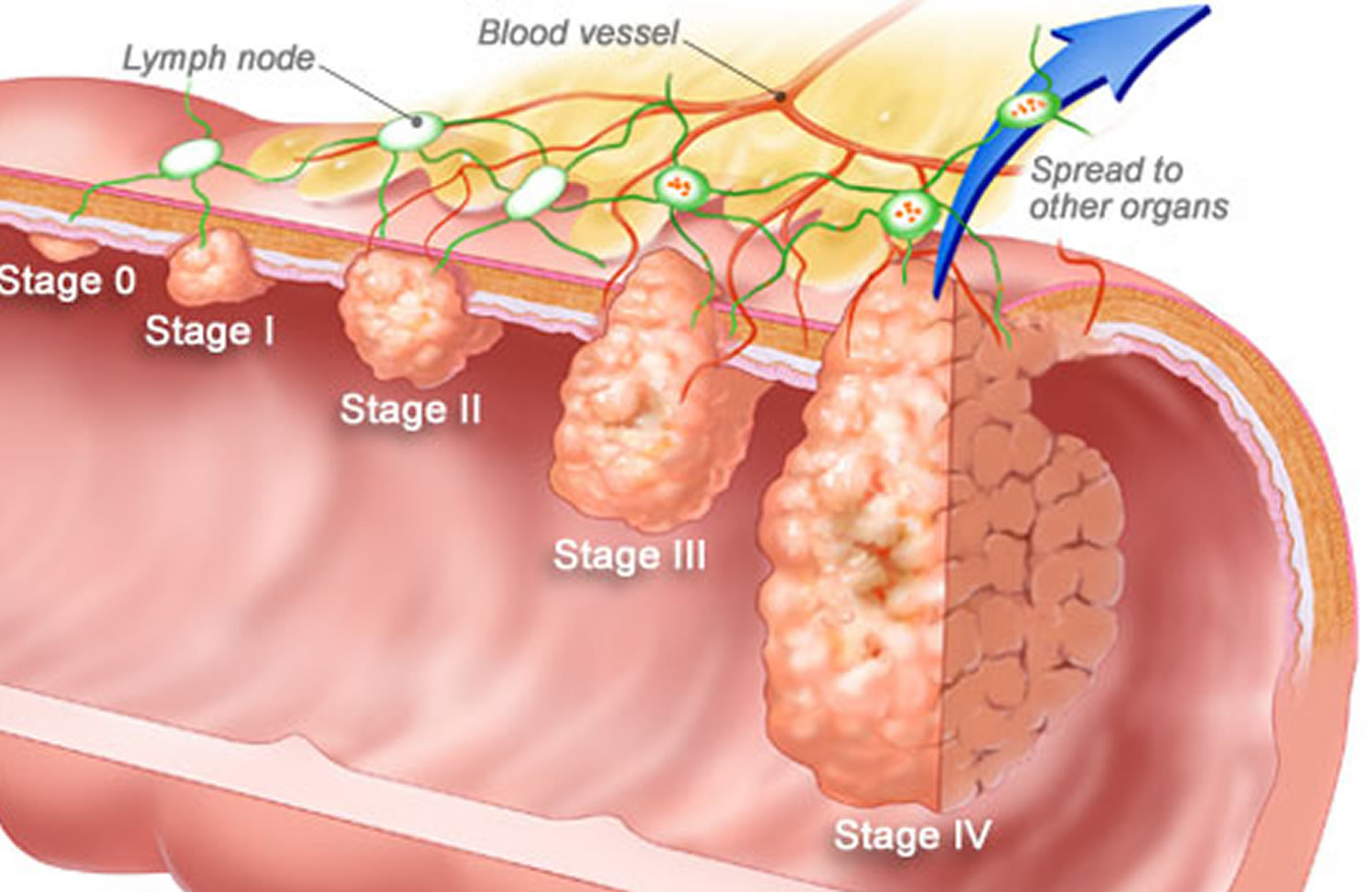 Cuanto tarda un pólipo en el colon en ser cancerígeno