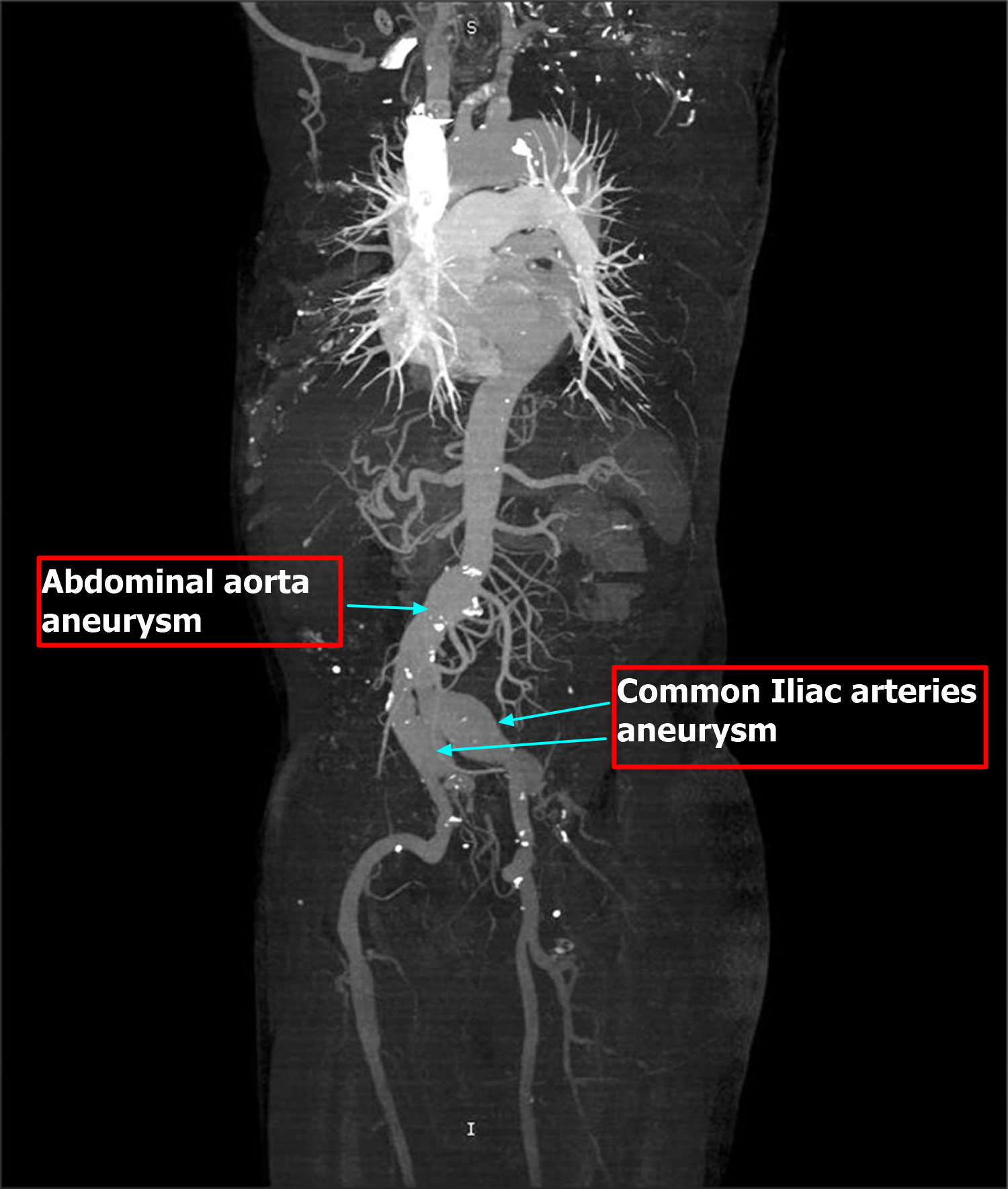 common iliac arteries aneurysm