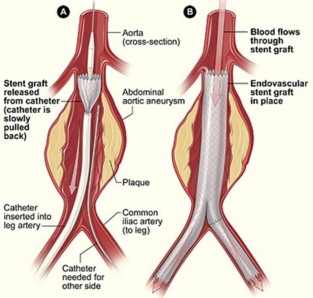 Aorta Anatomy Function Branches Location And Aorta Problems 7300