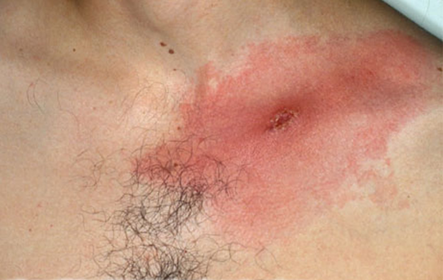 expanding lyme disease rash with central crust