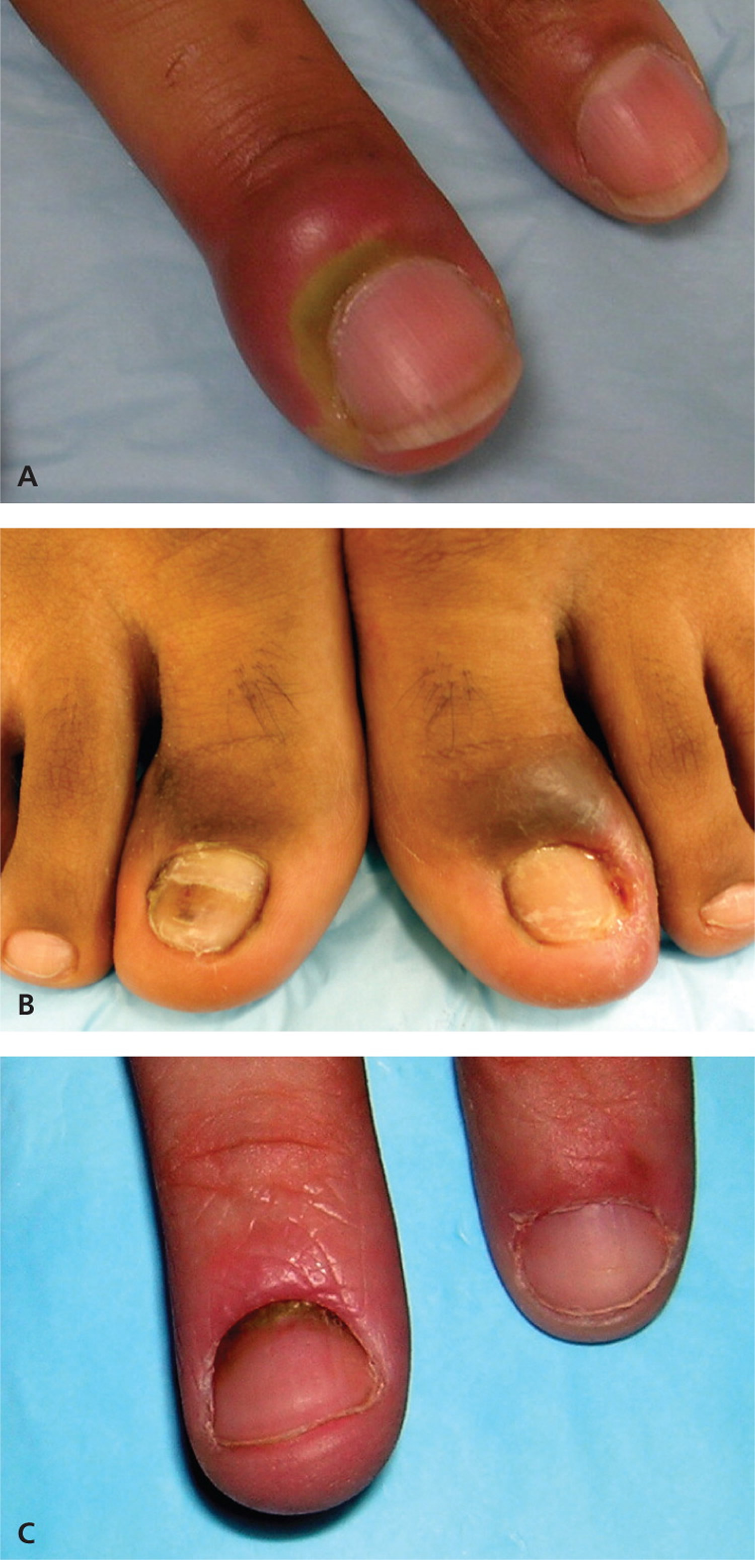 Erythrodermic paraneoplastic dermatomyositis | CMAJ