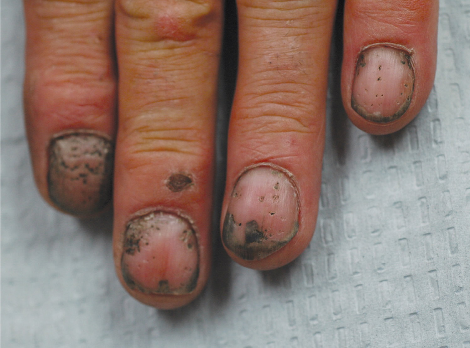 fingernail pitting of psoriasis