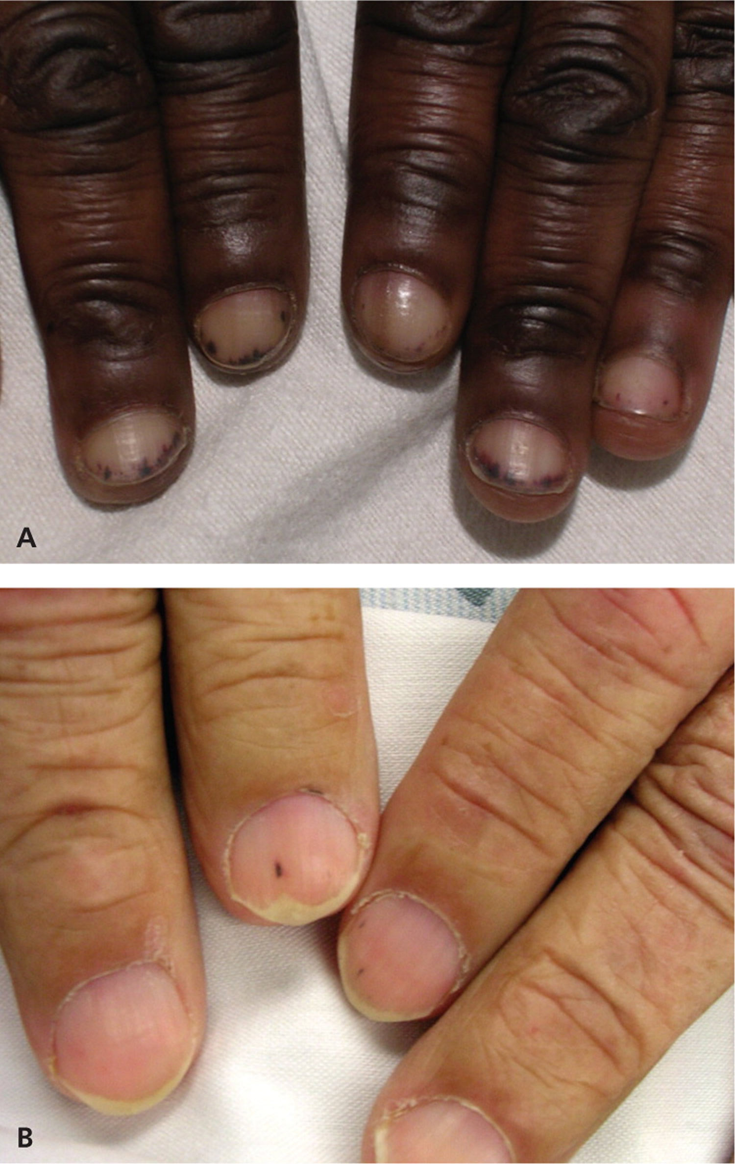 fingernail splinter hemorrhage