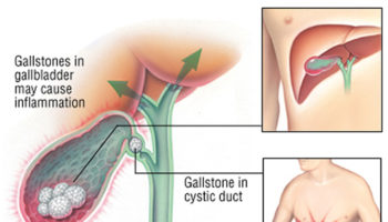 gallbladder pain