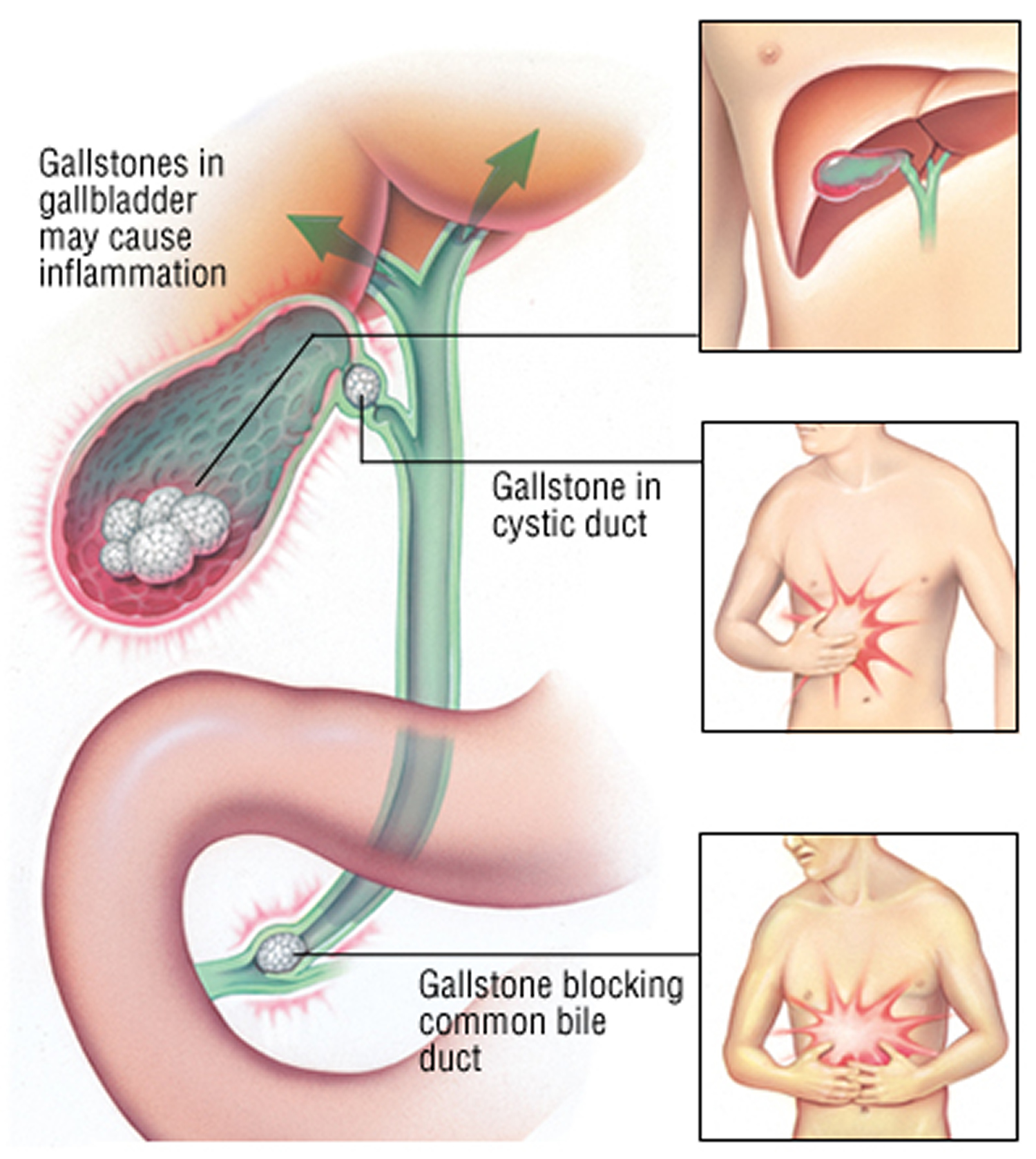 gallbladder pain