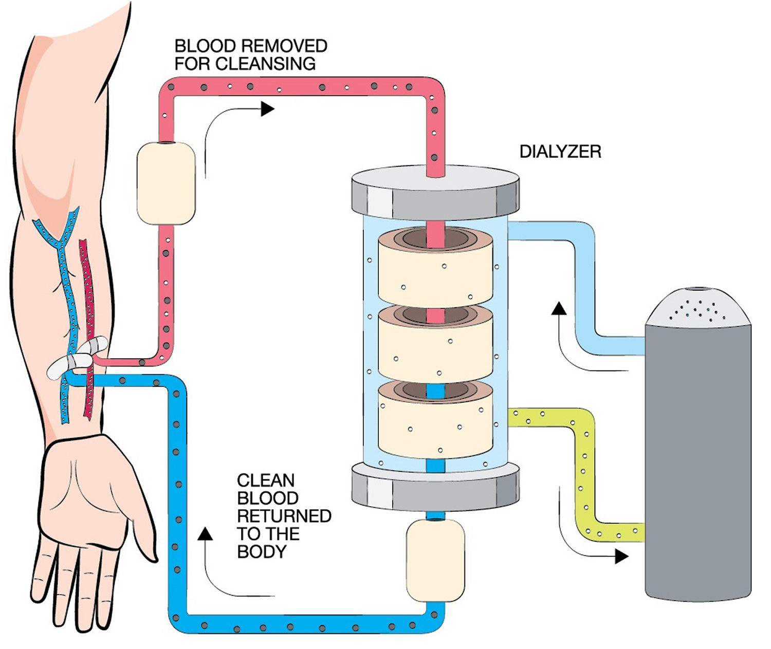 hemodialysis for kidney failure