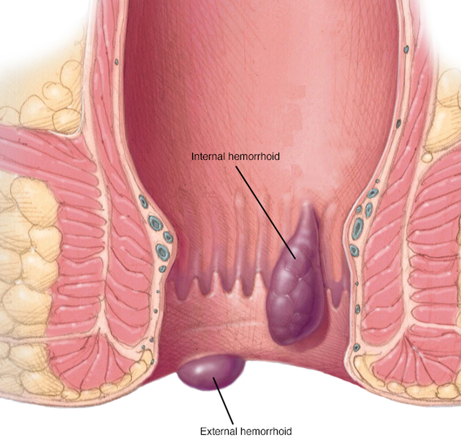 Signs and Symptoms of Anal Cancer