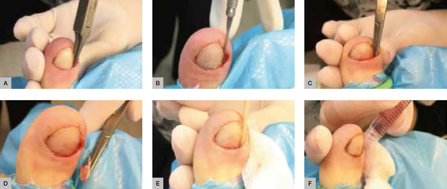 ingrown toenail surgery - phenol matrixectomy