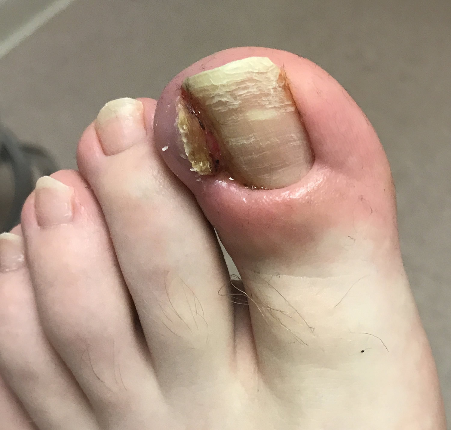 Does anyone here know what happened to the corner of my toe? It hurts  whenever I put pressure in it. : r/popping