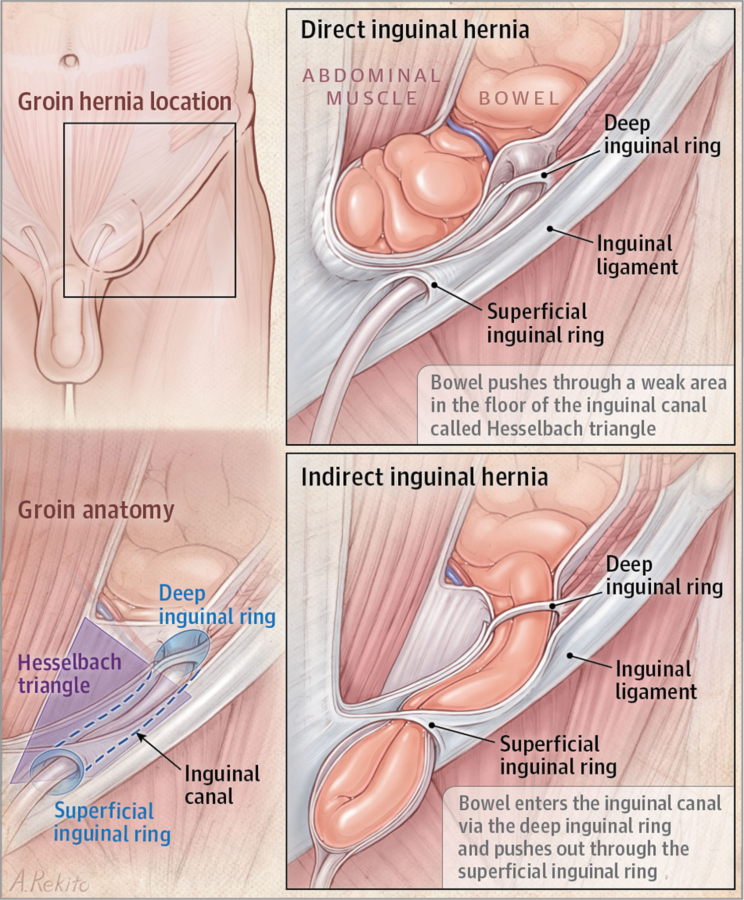 Inguinal canal | Radiology Reference Article | Radiopaedia.org