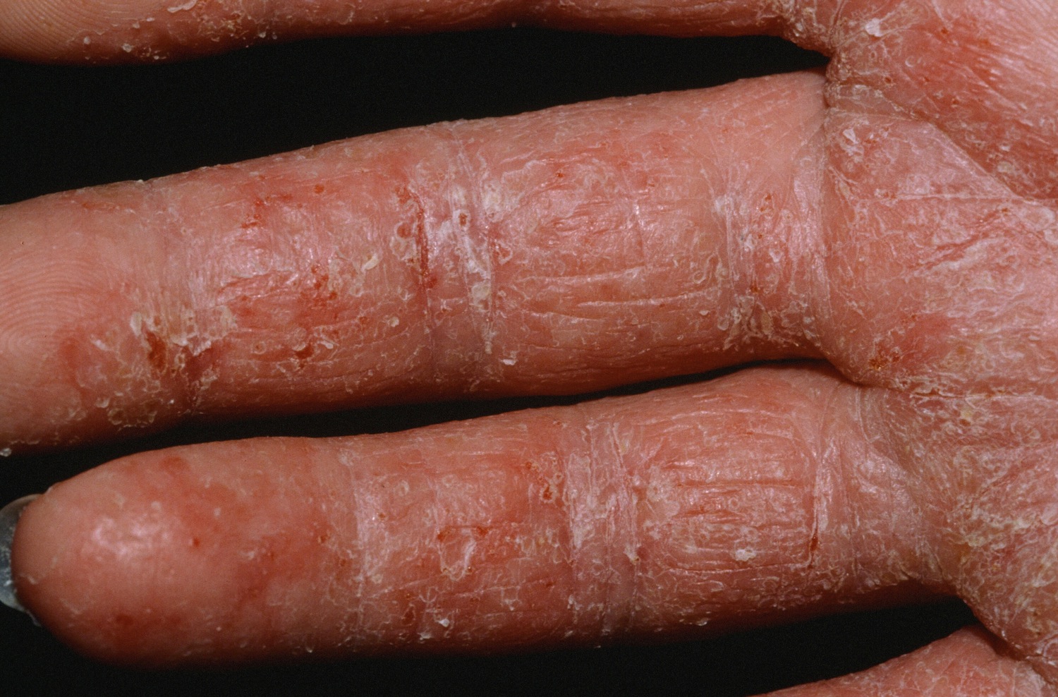 mild dermatitis herpetiformis on hands
