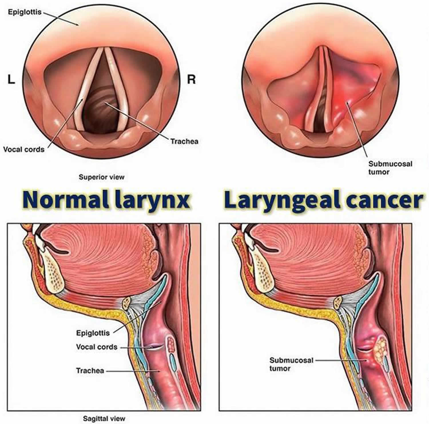 larynx cancer