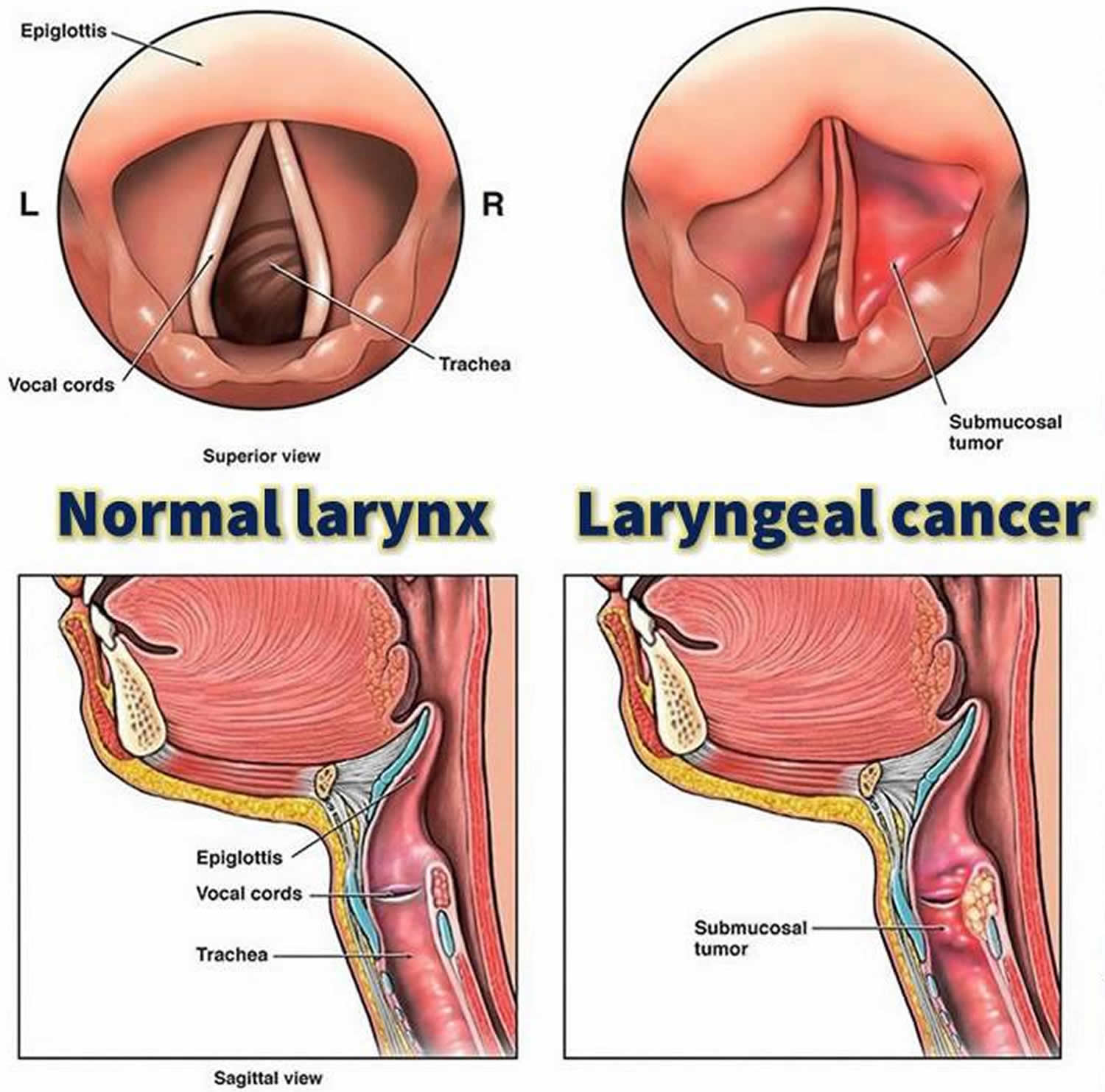 larynx-anatomy-function-in-respiratory-system-cancer-symptoms