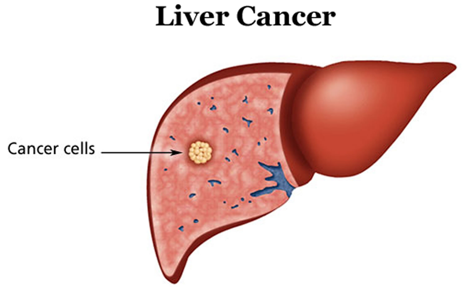 liver tumor