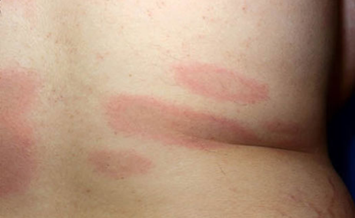 Lyme Disease Rash Causes Symptoms Diagnosis And Treatment