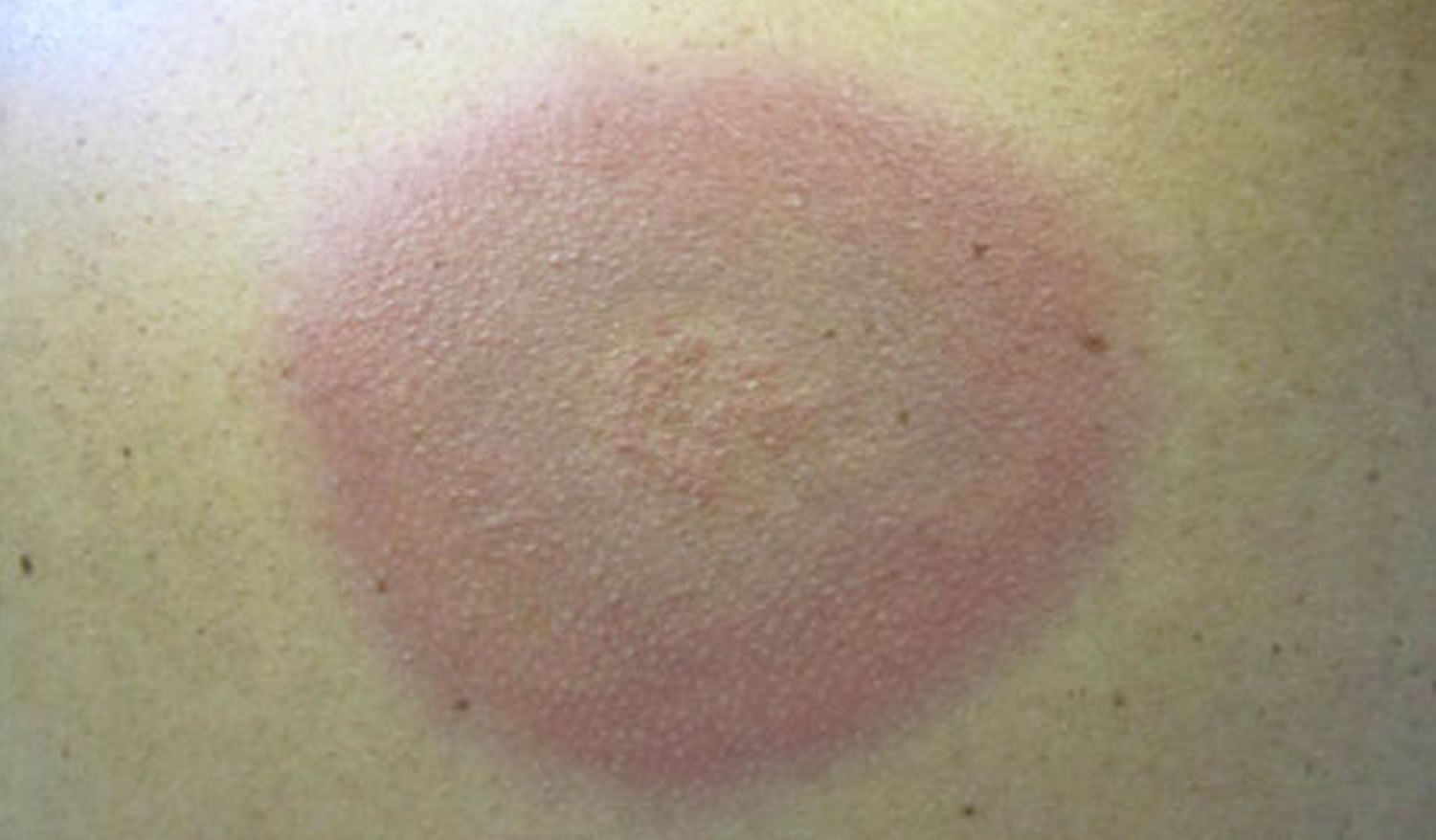 lyme disease rash - bluish rash with no central clearing