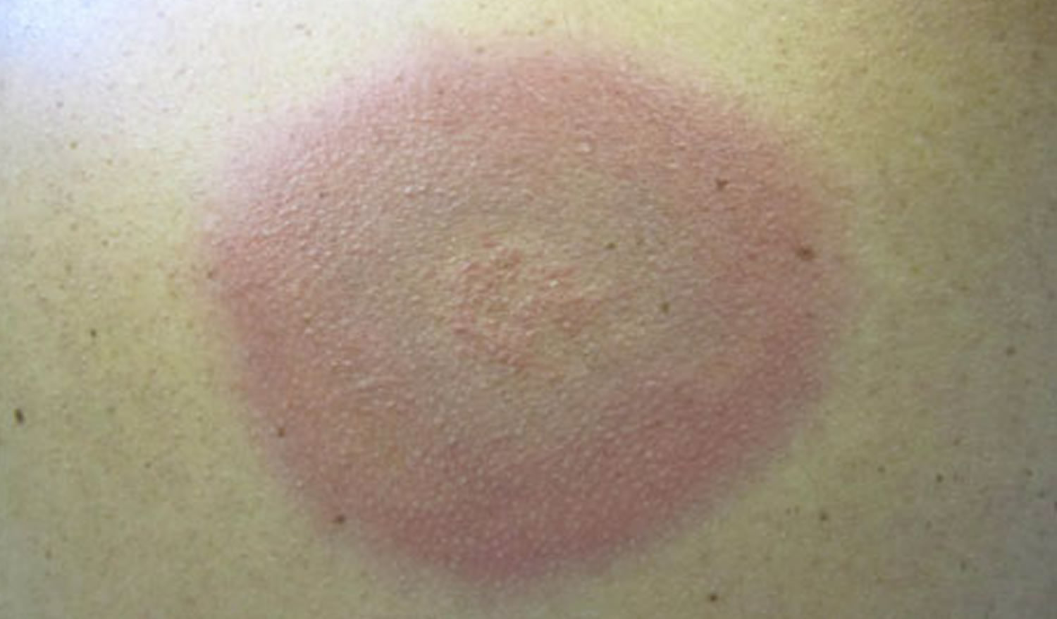 Lyme Disease Rash Causes Symptoms Diagnosis And Treatment