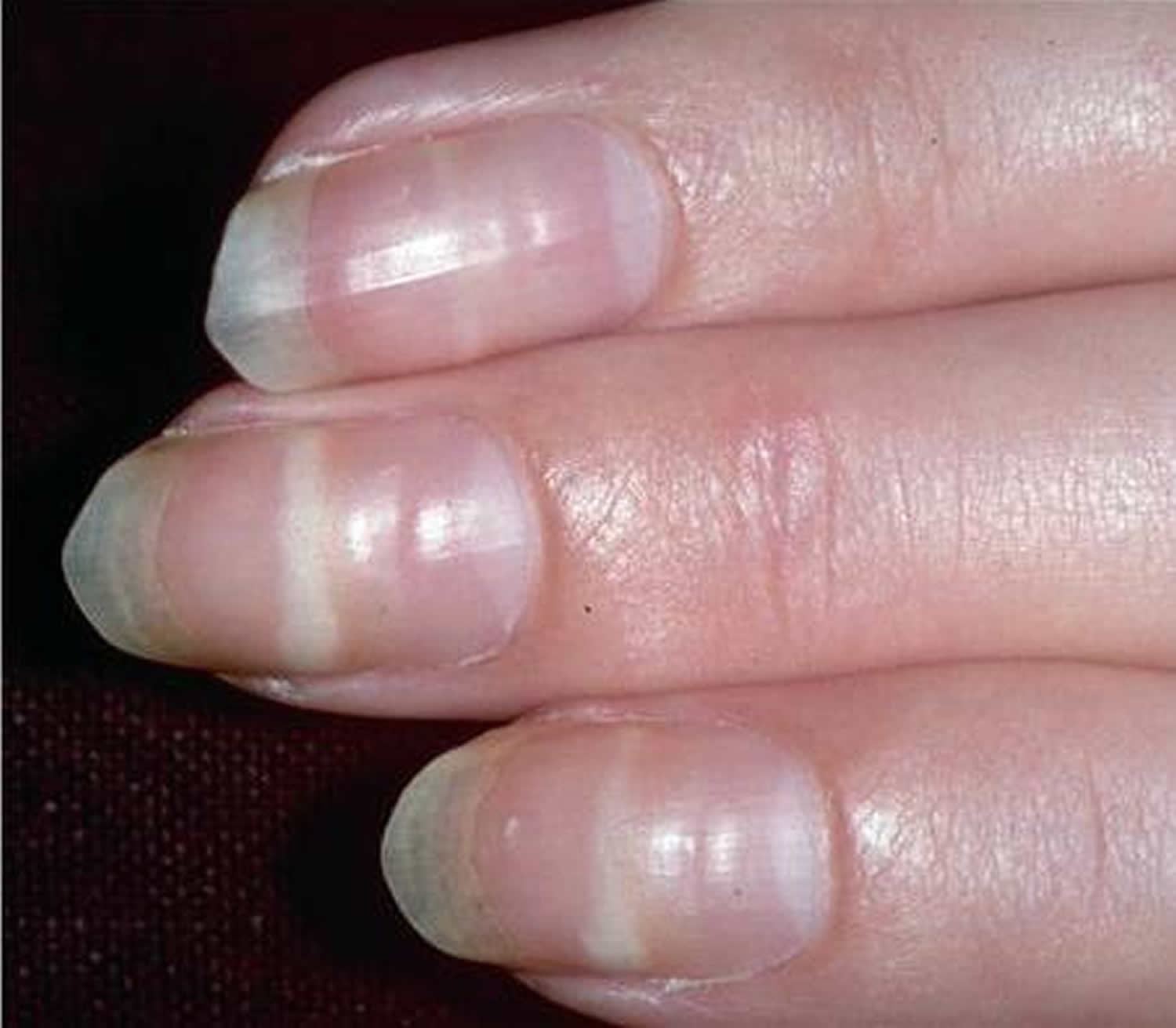 Nail Changes | Nail Diseases | Medical Dermatology Lebanon