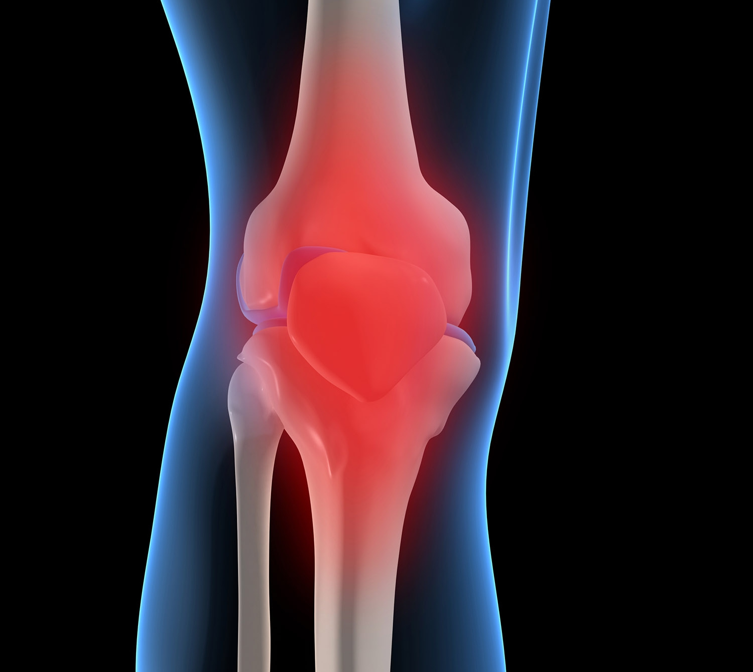 Лечение артрита суставов в домашних условиях. Остеоартрит коленного сустава. Феморопателлярный артроз коленного сустава что это. Коленный сустав остеартрит. Эпикондилит коленного сустава.