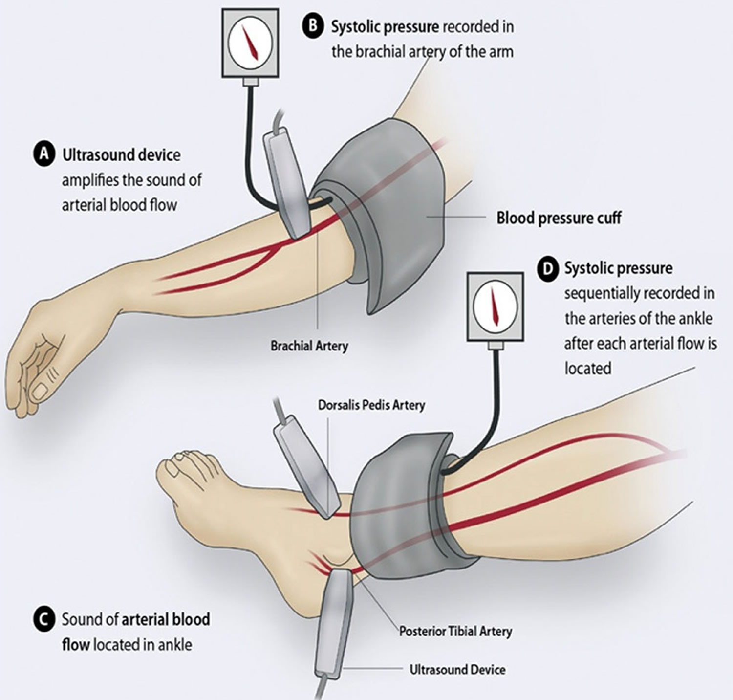 Peripheral Artery Disease - Causes, Symptoms & Treatment