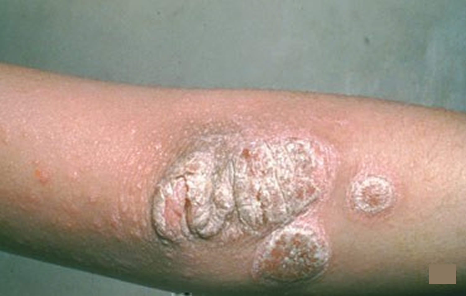 plaque psoriasis