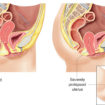 prolapsed uterus – severe
