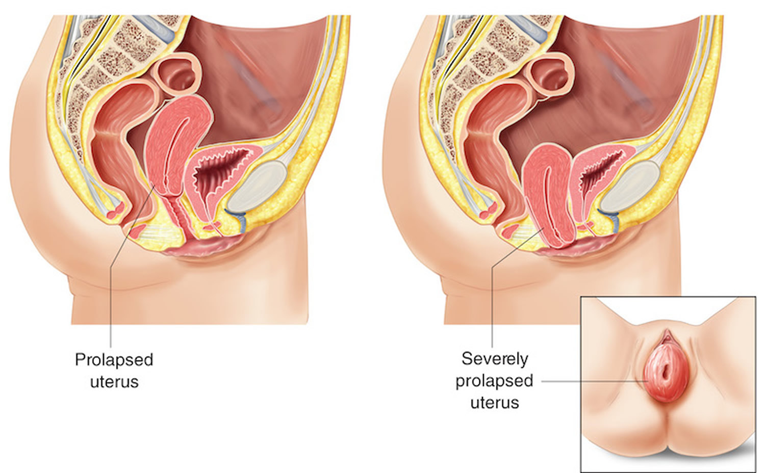 Uterine prolapse occurs when the uterus drops into the vagina. Uterine  prolapse occurs when the pelvic muscles and ligaments that suppor