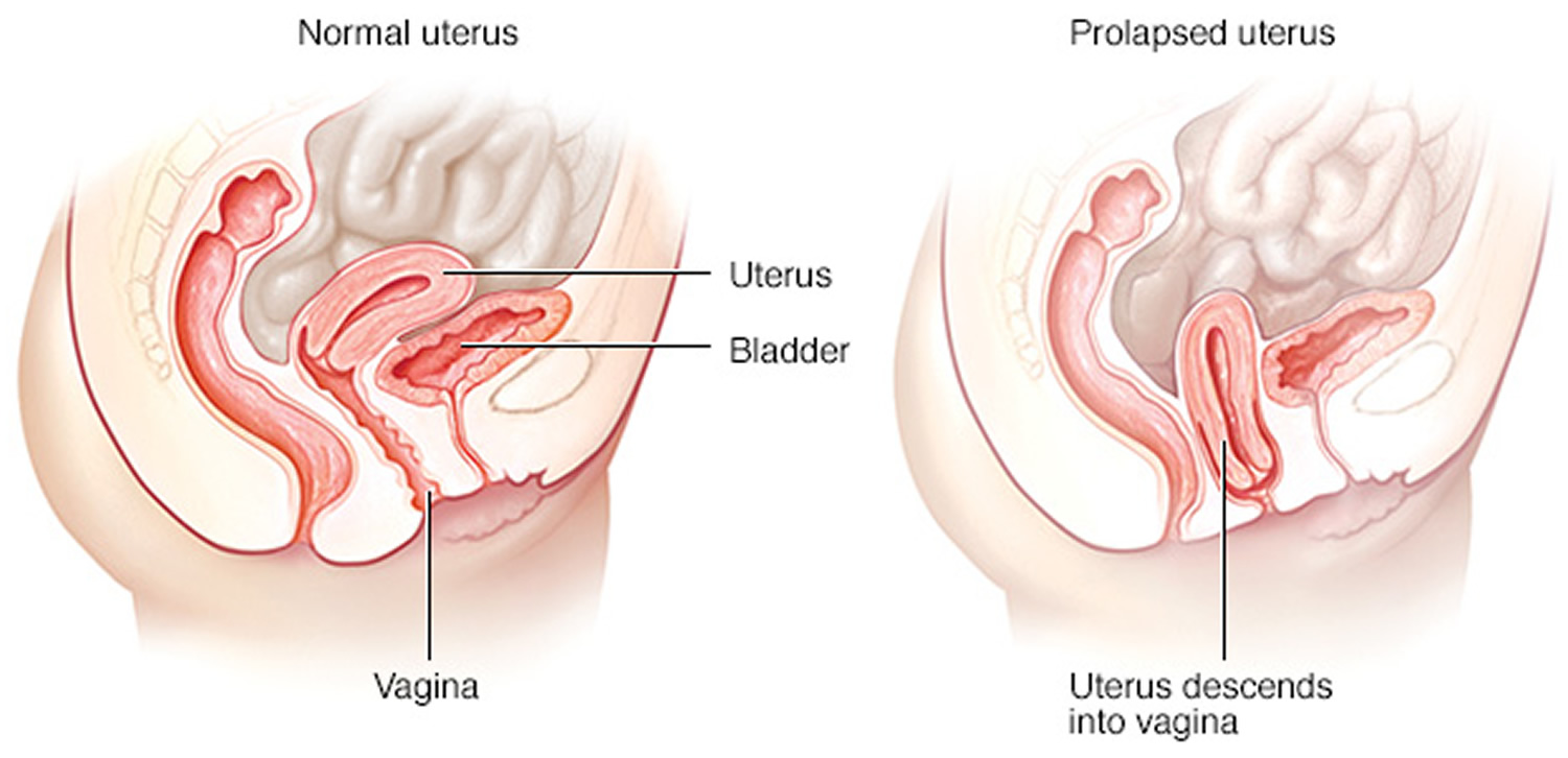 Medical Illustration Showing Difference Normal Uterus Prolapsed Uterus  Annotations Explaining Stock Vector by ©rob3000 404251672