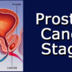 prostate cancer