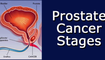 prostate cancer