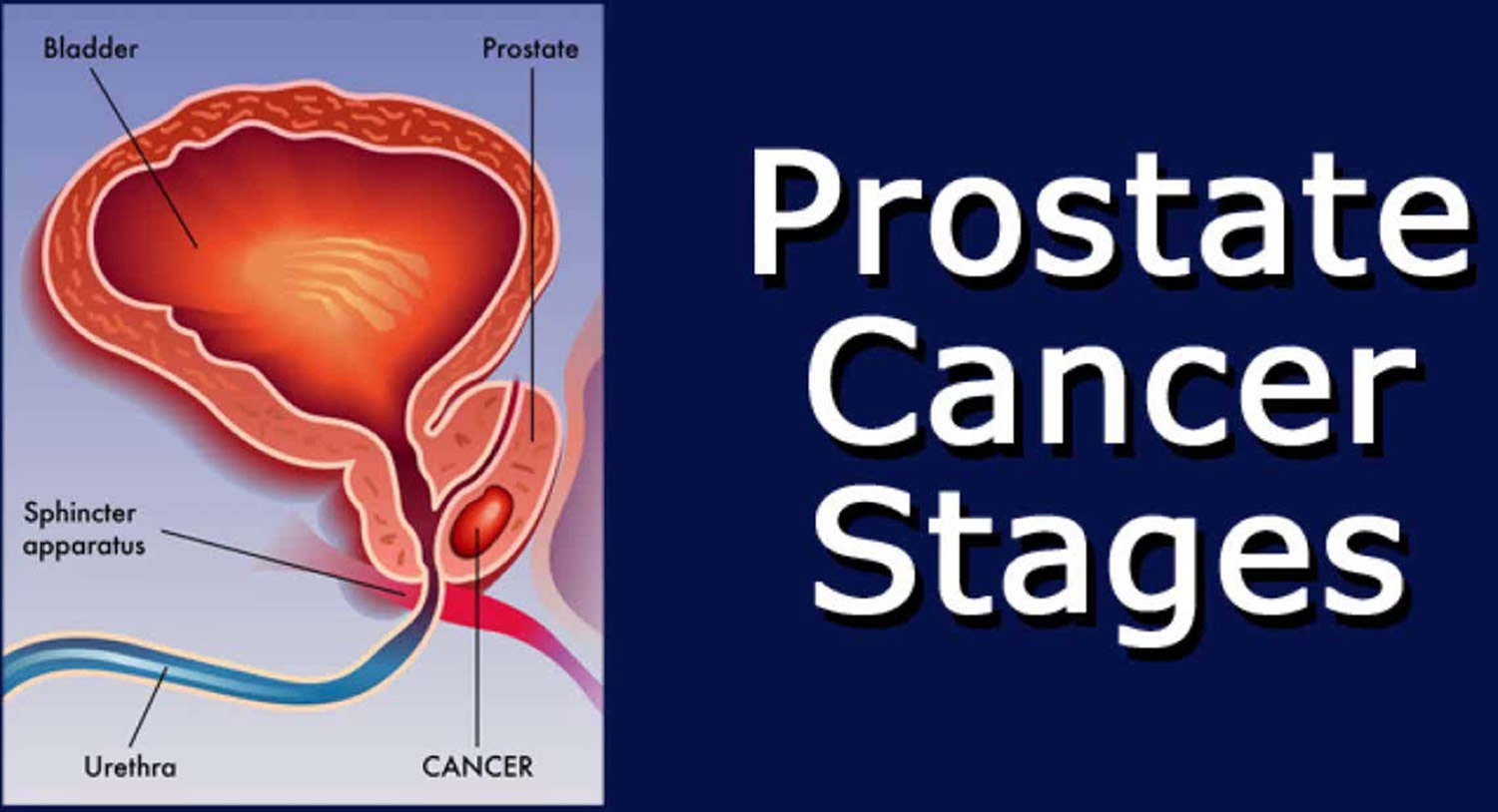 Early stage prostate cancer