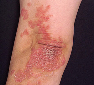 Psoriasis - Appearance, Causes, Types, Symptoms, Treatment, and Diet