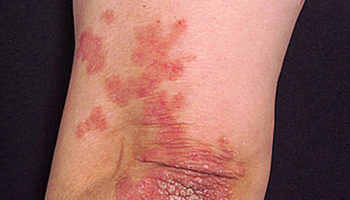 psoriasis