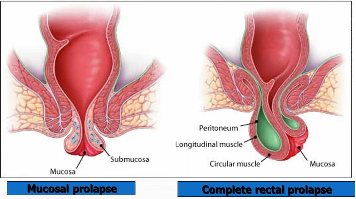 Rectal Prolapse - Causes, Symptoms and Treatment with Surgery