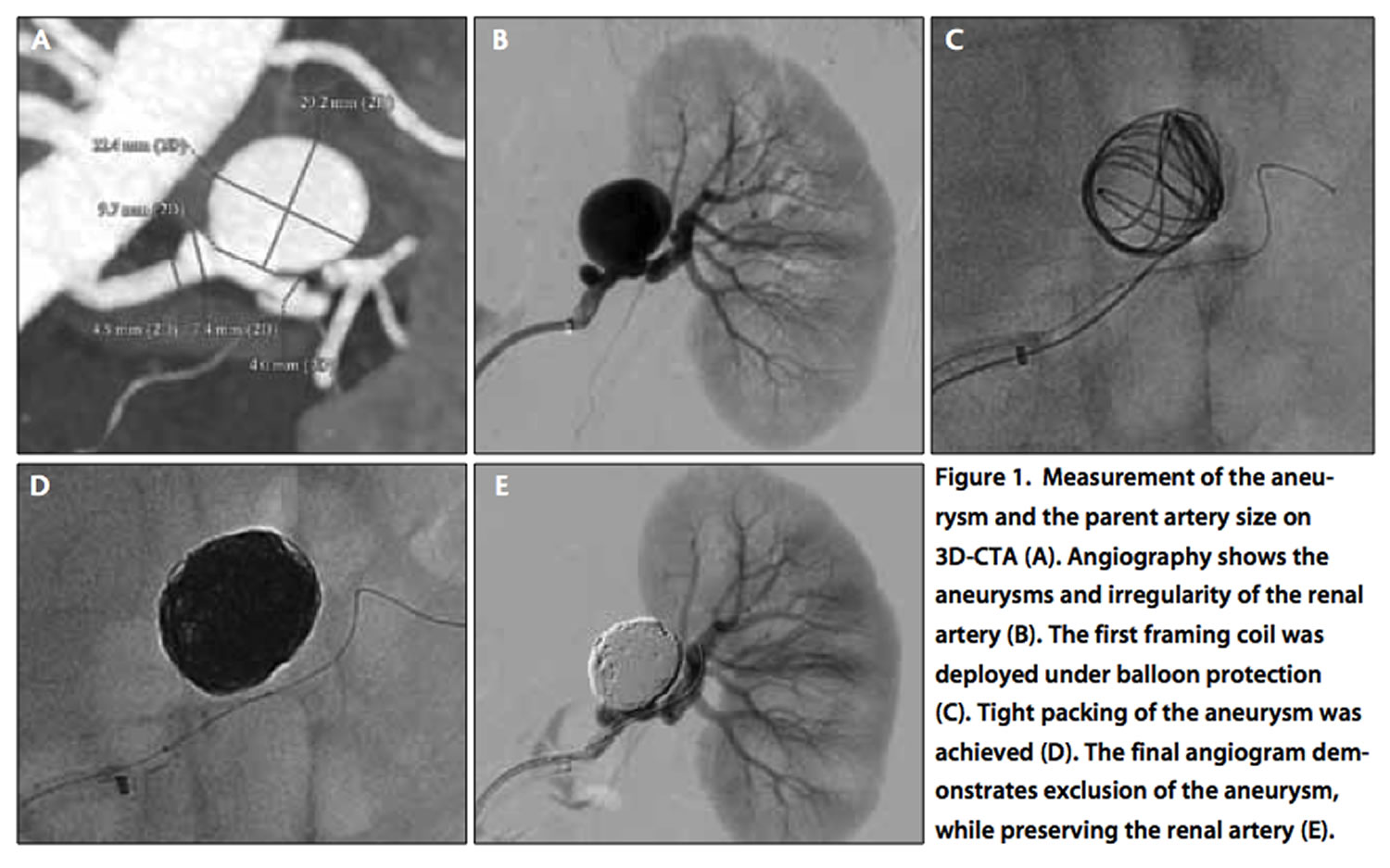 renal-artery-aneurysm