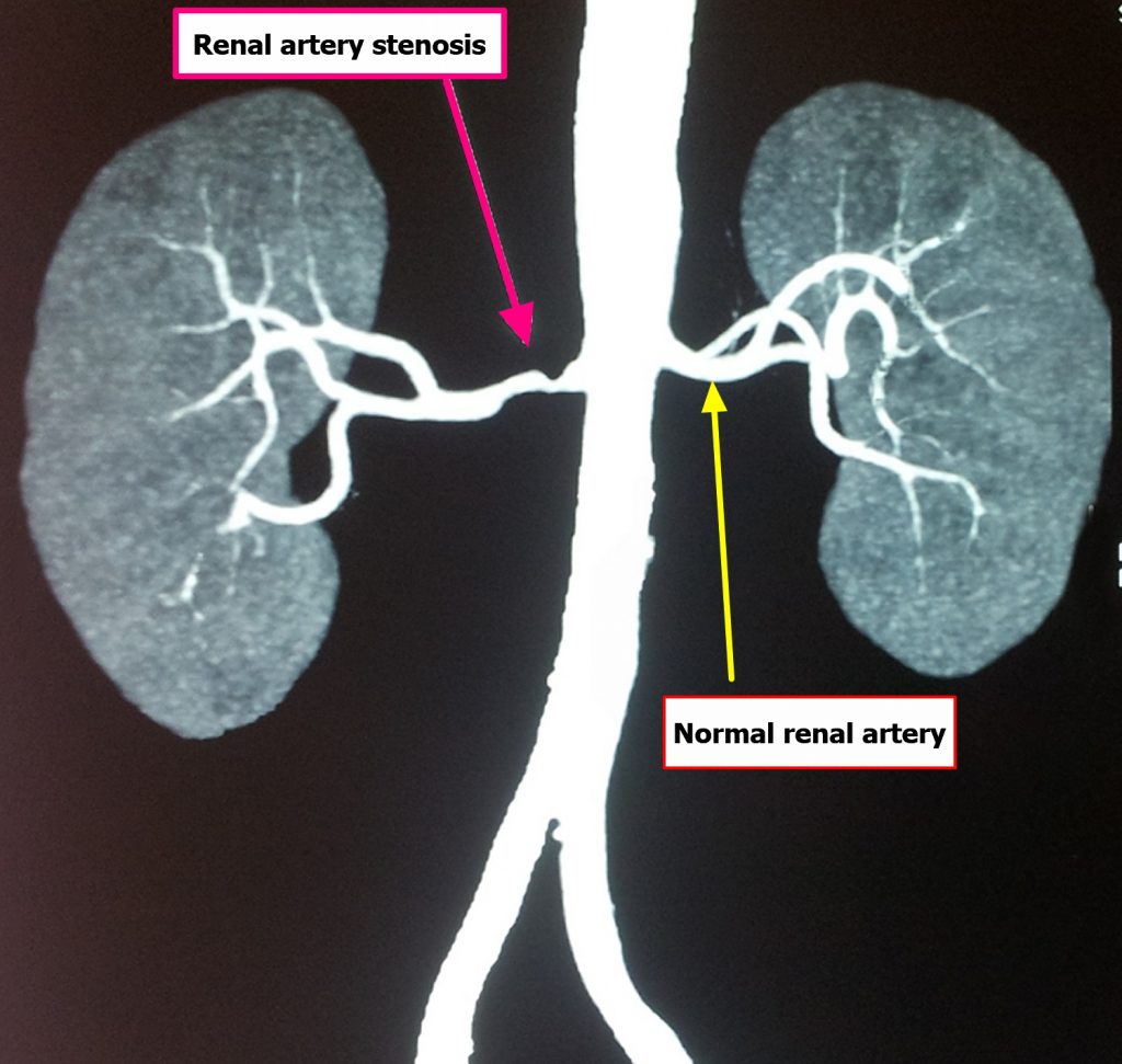 renal-artery-function-renal-artery-stenosis-and-renal-artery-aneurysm