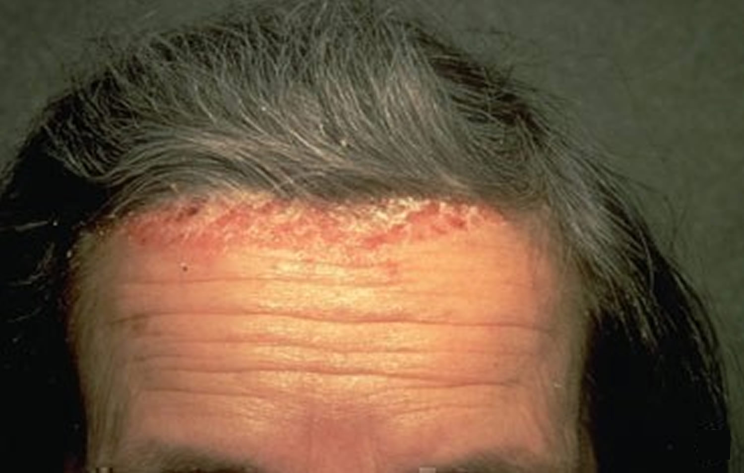 scalp psoriasis