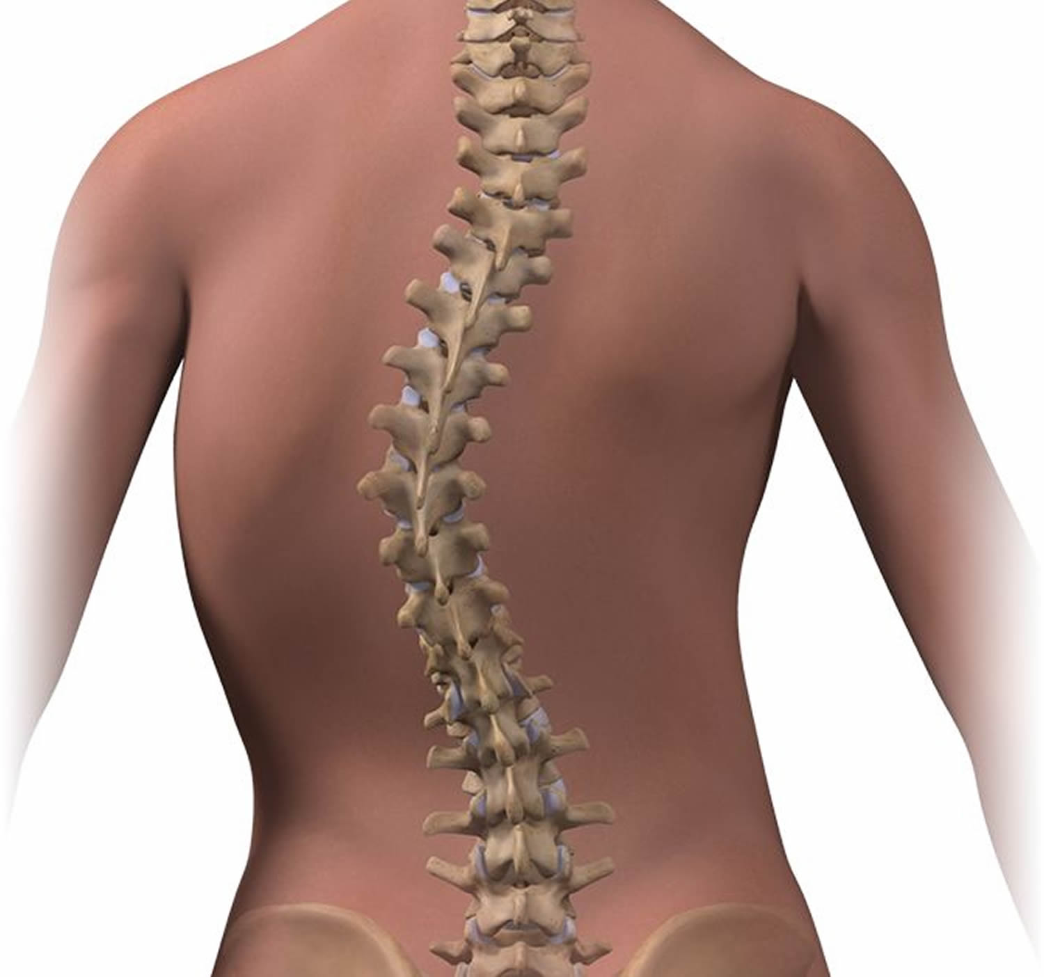 Scoliosis Adults Children Causes Treatment Brace Exercise