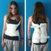 Scoliosis - Adults & Children - Causes, Treatment, Brace, Exercise